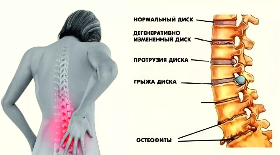 Остеохондроз стадии