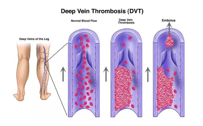 dvt--тгв.jpg