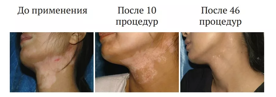 Ультрафиолетовый облучатель для фототерапии Kernel KN 4006
