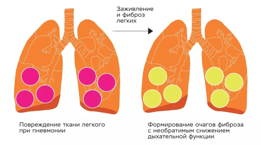 Фиброз легких