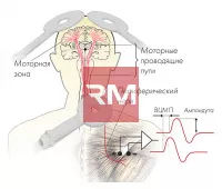 Аппарат транскраниальной магнитной стимуляции NEURO-MSX - 5