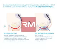 ЭЛЕКТРОМАГНИТНОЕ КРЕСЛО ДЛЯ УКРЕПЛЕНИЯ МЫШЦ ТАЗОВОГО ДНА BTL EMSELLA - 5