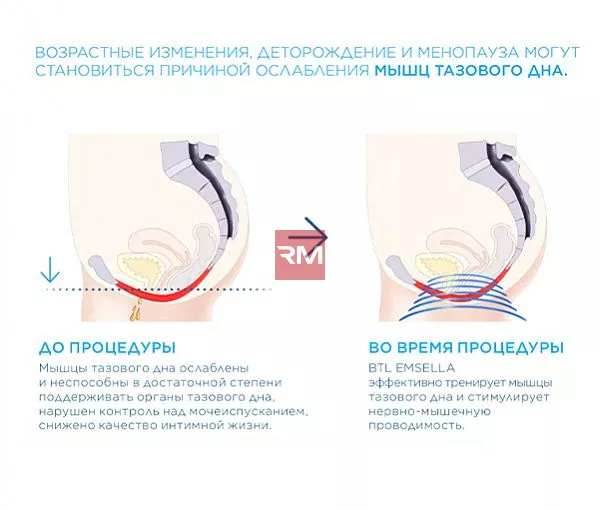 ЭЛЕКТРОМАГНИТНОЕ КРЕСЛО ДЛЯ УКРЕПЛЕНИЯ МЫШЦ ТАЗОВОГО ДНА BTL EMSELLA - 5
