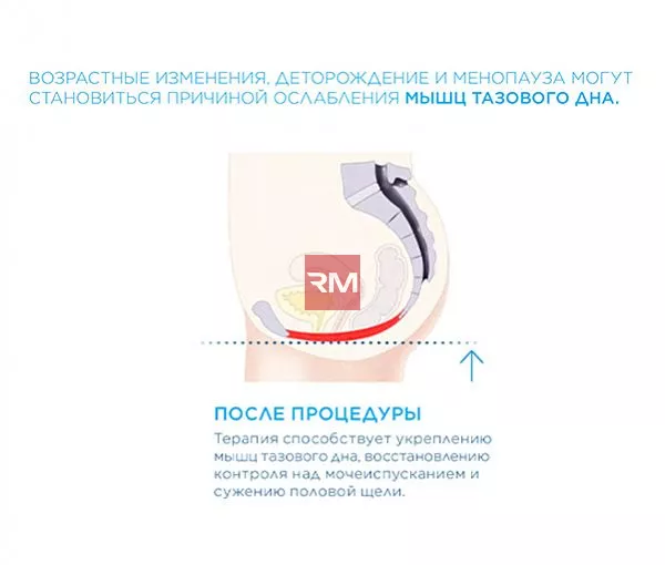 ЭЛЕКТРОМАГНИТНОЕ КРЕСЛО ДЛЯ УКРЕПЛЕНИЯ МЫШЦ ТАЗОВОГО ДНА BTL EMSELLA - 6